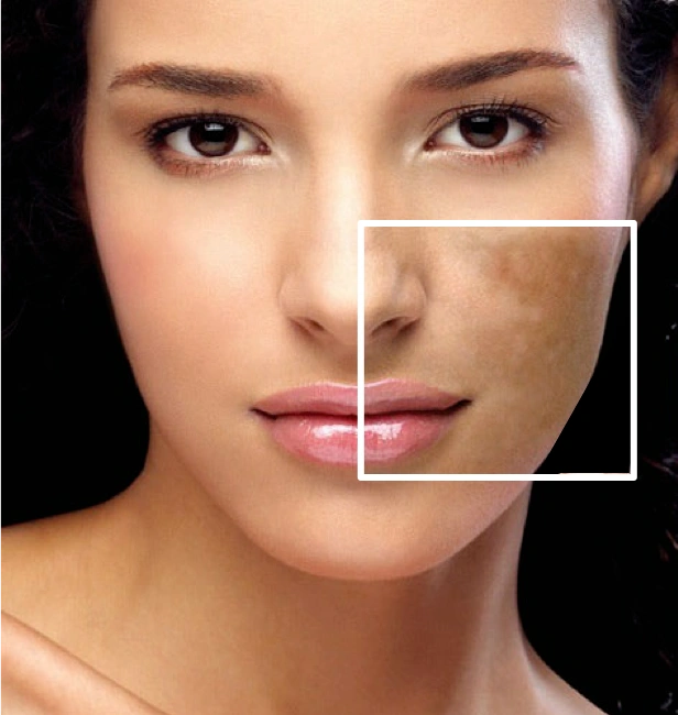 Pigmentation Treatment in Dubai
