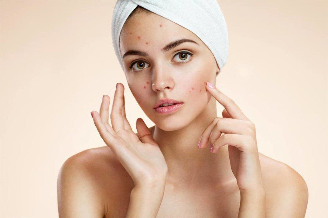 Treating Adult Acne: Professional Dermatology Solutions