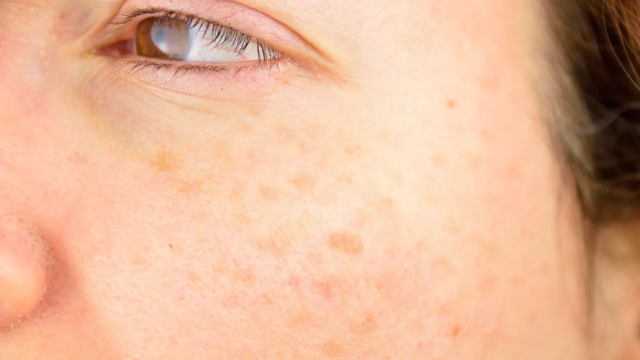 How Sun Damage Affects Skin Over Time