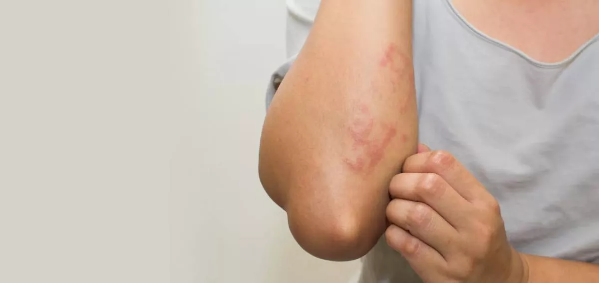 Skin Allergies: Common Triggers and Treatments